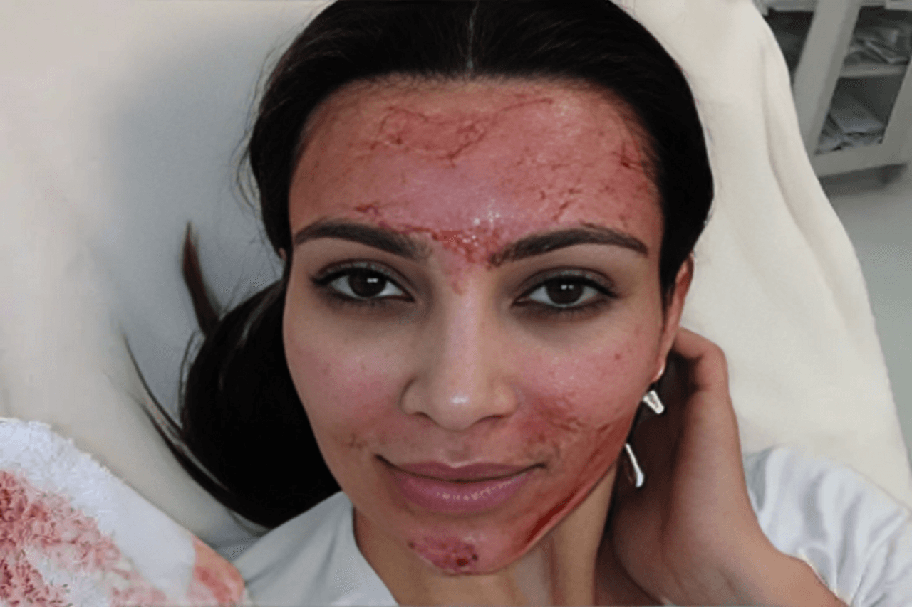 3 Things you must know about Menstrual Blood Facials! 